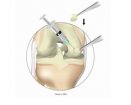 TiGenix ChondroCelect | Used in Articular cartilage repair | Which Medical Device